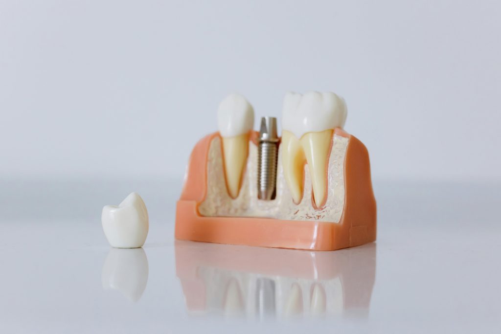 dental implant model